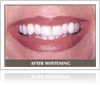 Teeth whitening results